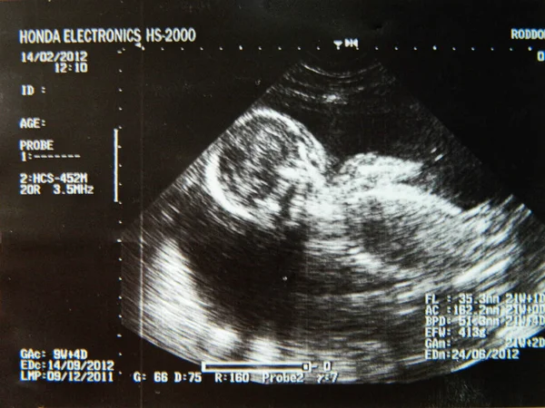 Obstetric Ultrasonography Ultrasound Echography Fourth Month Fetus High Quality Photo — Stock Photo, Image