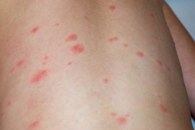 Doğal aşılama. Bulaşıcı bir hastalık. Suçiçeği hastası bir çocuk. Varicella virüsü ya da çocuk vücudunda ve yüzünde su çiçeği kabarcığı kızarıklığı. Yüksek kalite fotoğraf