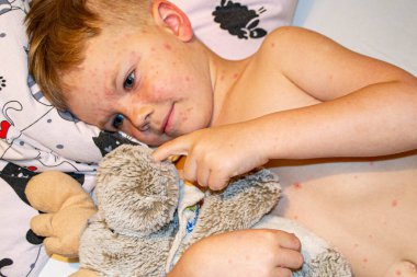 Doğal aşılama. Bulaşıcı bir hastalık. Suçiçeği hastası bir çocuk. Varicella virüsü ya da çocuk vücudunda ve yüzünde su çiçeği kabarcığı kızarıklığı. Yüksek kalite fotoğraf