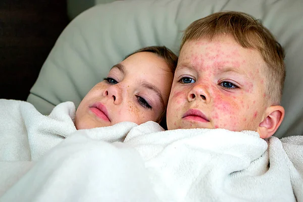 Vacunación Natural Entre Hermano Hermana Enfermedad Contagiosa Niña Enferma Con — Foto de Stock