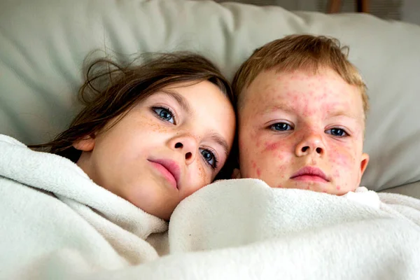 Vacunación Natural Entre Hermano Hermana Enfermedad Contagiosa Niña Enferma Con — Foto de Stock