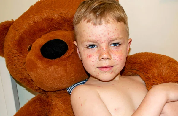 Natural Vaccination Contagious Disease Sick Boy Chickenpox Toy Bear Varicella — Stock Photo, Image