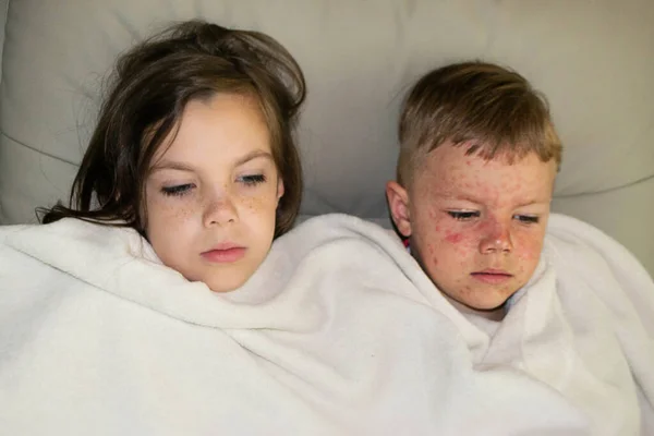Natural Vaccination Brother Sister Contagious Disease Sick Child Chickenpox Varicella — Stock Photo, Image
