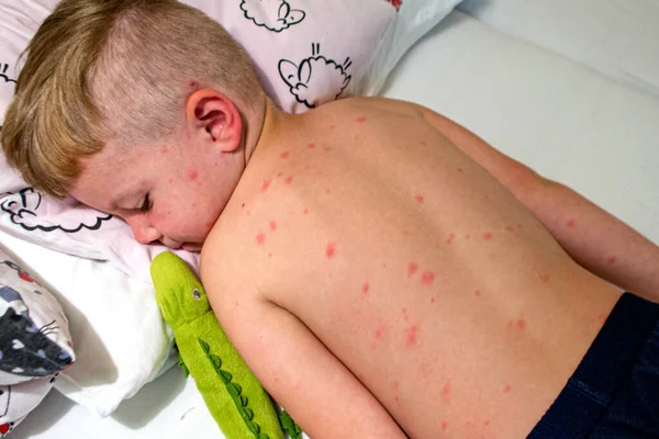 Vacunación Natural Enfermedad Contagiosa Niña Enferma Con Varicela Virus Varicela — Foto de Stock