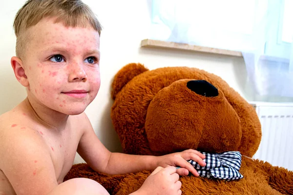 Natural Vaccination Contagious Disease Sick Boy Chickenpox Toy Bear Varicella — Stock Photo, Image