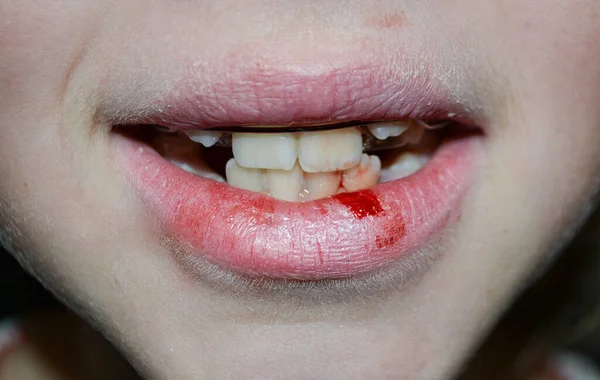 Dry and damaged lips of a girl. Close-up. Lip fissure and bleeding. Sick cracked damaged tissue. Dry lips with cracks, dry mouth, Closeup face with brittle and dry lips, dehydration High quality photo