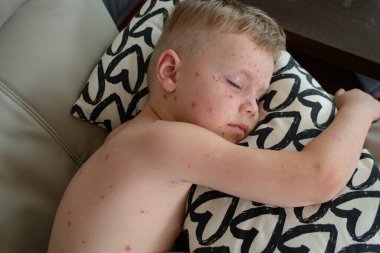 Doğal aşılama. Bulaşıcı bir hastalık. Suçiçeği hastası bir çocuk. Varicella virüsü ya da çocuk vücudunda ve yüzünde su çiçeği kabarcığı kızarıklığı. Yüksek kalite fotoğraf