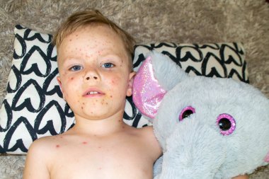 Doğal aşılama. Bulaşıcı bir hastalık. Suçiçeği hastası bir çocuk. Varicella virüsü ya da çocuk vücudunda ve yüzünde su çiçeği kabarcığı kızarıklığı. Yüksek kalite fotoğraf