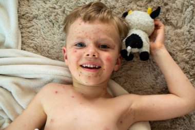 Doğal aşılama. Bulaşıcı bir hastalık. Suçiçeği hastası bir çocuk. Varicella virüsü ya da çocuk vücudunda ve yüzünde su çiçeği kabarcığı kızarıklığı. Yüksek kalite fotoğraf