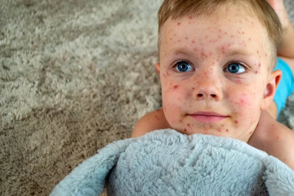 Vacunación Natural Enfermedad Contagiosa Niña Enferma Con Varicela Virus Varicela — Foto de Stock