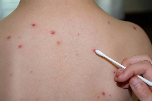 Vacunación Natural Enfermedad Contagiosa Niña Enferma Con Varicela Virus Varicela — Foto de Stock