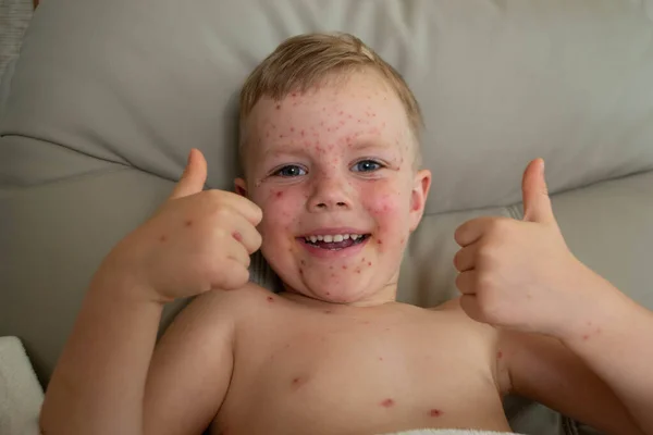 Vacunación Natural Enfermedad Contagiosa Niña Enferma Con Varicela Virus Varicela — Foto de Stock