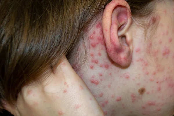 Vacunación Natural Enfermedad Contagiosa Niña Enferma Con Varicela Virus Varicela — Foto de Stock