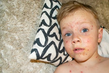 Doğal aşılama. Bulaşıcı bir hastalık. Suçiçeği hastası bir çocuk. Varicella virüsü ya da çocuk vücudunda ve yüzünde su çiçeği kabarcığı kızarıklığı. Yüksek kalite fotoğraf