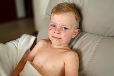 Doğal aşılama. Bulaşıcı bir hastalık. Suçiçeği hastası bir çocuk. Varicella virüsü ya da çocuk vücudunda ve yüzünde su çiçeği kabarcığı kızarıklığı. Yüksek kalite fotoğraf