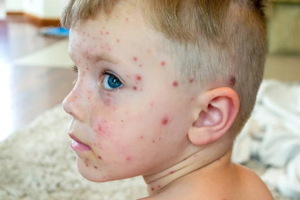 Vaccinazione Naturale Malattie Contagiose Bambino Malato Con Varicella Virus Della — Foto Stock