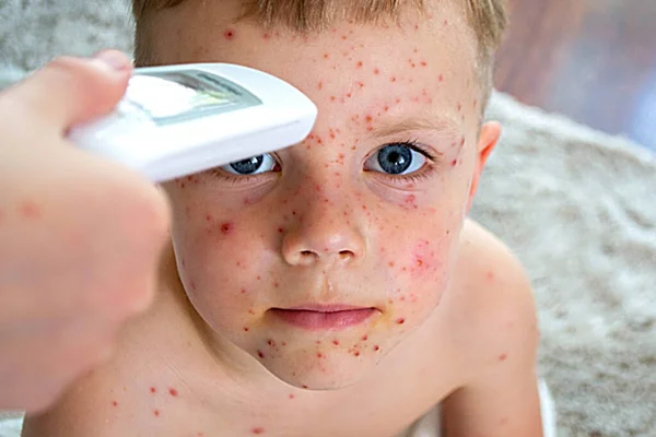 Natuurlijke Vaccinatie Besmettelijke Ziekte Ziek Kind Met Waterpokken Varicella Virus — Stockfoto