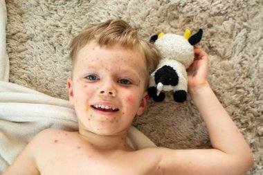 Doğal aşılama. Bulaşıcı bir hastalık. Suçiçeği hastası bir çocuk. Varicella virüsü ya da çocuk vücudunda ve yüzünde su çiçeği kabarcığı kızarıklığı. Yüksek kalite fotoğraf