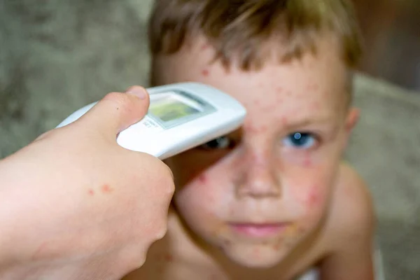 Natuurlijke Vaccinatie Besmettelijke Ziekte Ziek Kind Met Waterpokken Varicella Virus — Stockfoto