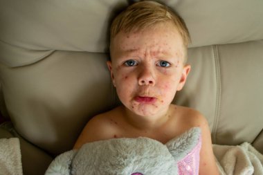 Doğal aşılama. Bulaşıcı bir hastalık. Suçiçeği hastası bir çocuk. Varicella virüsü ya da çocuk vücudunda ve yüzünde su çiçeği kabarcığı kızarıklığı. Yüksek kalite fotoğraf