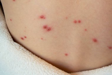 Doğal aşılama. Bulaşıcı bir hastalık. Suçiçeği hastası bir çocuk. Varicella virüsü ya da çocuk vücudunda ve yüzünde su çiçeği kabarcığı kızarıklığı. Yüksek kalite fotoğraf