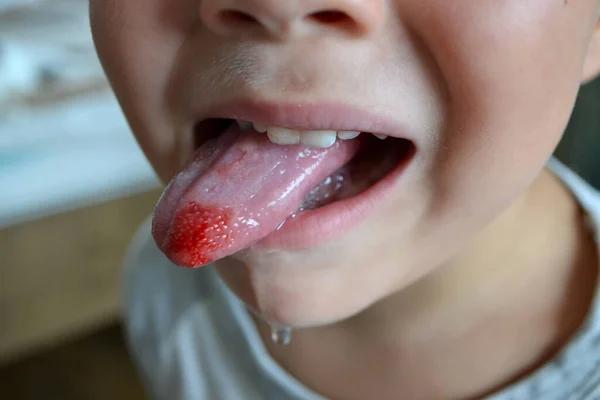 Childs Bitten Tongue Close Lips Tongue Protrusion Blood — Foto de Stock
