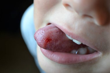 Childs bitten tongue. Close-up of lips, tongue, protrusion of blood