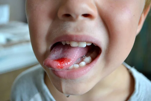 Childs Bitten Tongue Close Lips Tongue Protrusion Blood — Foto Stock