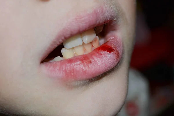 Dry Damaged Lips Girl Close Lip Fissure Bleeding Sick Cracked — Stock Photo, Image