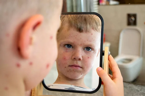 Natuurlijke Vaccinatie Besmettelijke Ziekte Ziek Kind Met Waterpokken Varicella Virus — Stockfoto