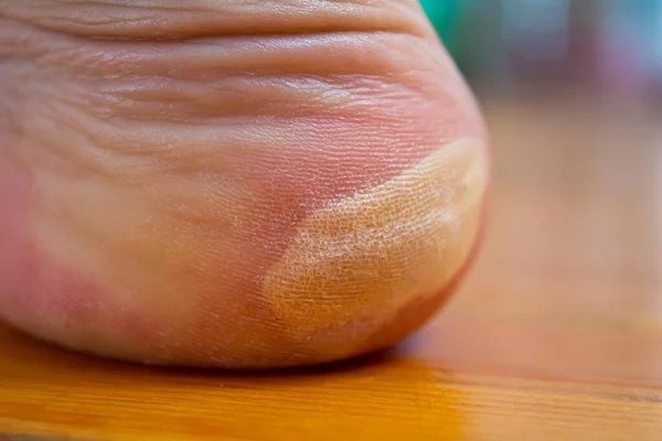 Blister on the foot. Foot injury concept. Health problems.