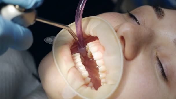 Young woman with a retractor in her mouth in a dental clinic. Brushing teeth with water. Dentist using saliva ejector or dental pump — Stock Video