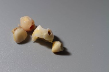 Bebeğin bakıcılıktan etkilenen süt dişleri çocuktan düştü..