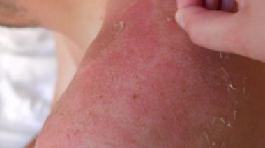 Sunburn: Closeup of Peeling sunburned skin on back and shoulder. Skin peels off after the strong sun. The hand helps to peel off the burnt skin from a sunburn