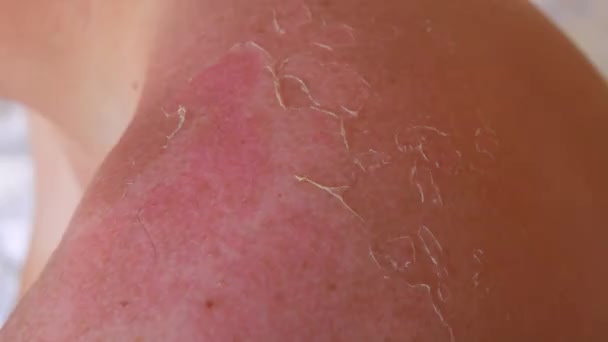 Sunburn Closeup Peeling Sunburned Skin Back Shoulder Skin Peels Strong — Stock Video