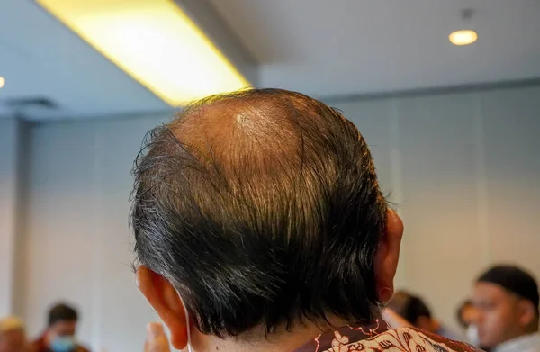 頭の中 後ろから見られる中年の男性が髪を失うを開始 彼は古い開始 ロイヤリティフリーのストック画像