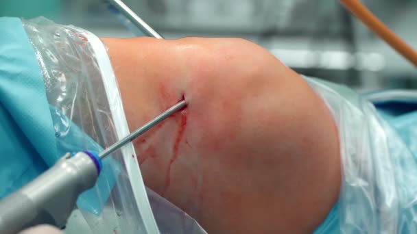 El cirujano coloca la cámara en la rodilla de los pacientes — Vídeos de Stock