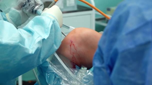 Ο χειρουργός τοποθετεί την κάμερα στο γόνατο των ασθενών — Αρχείο Βίντεο