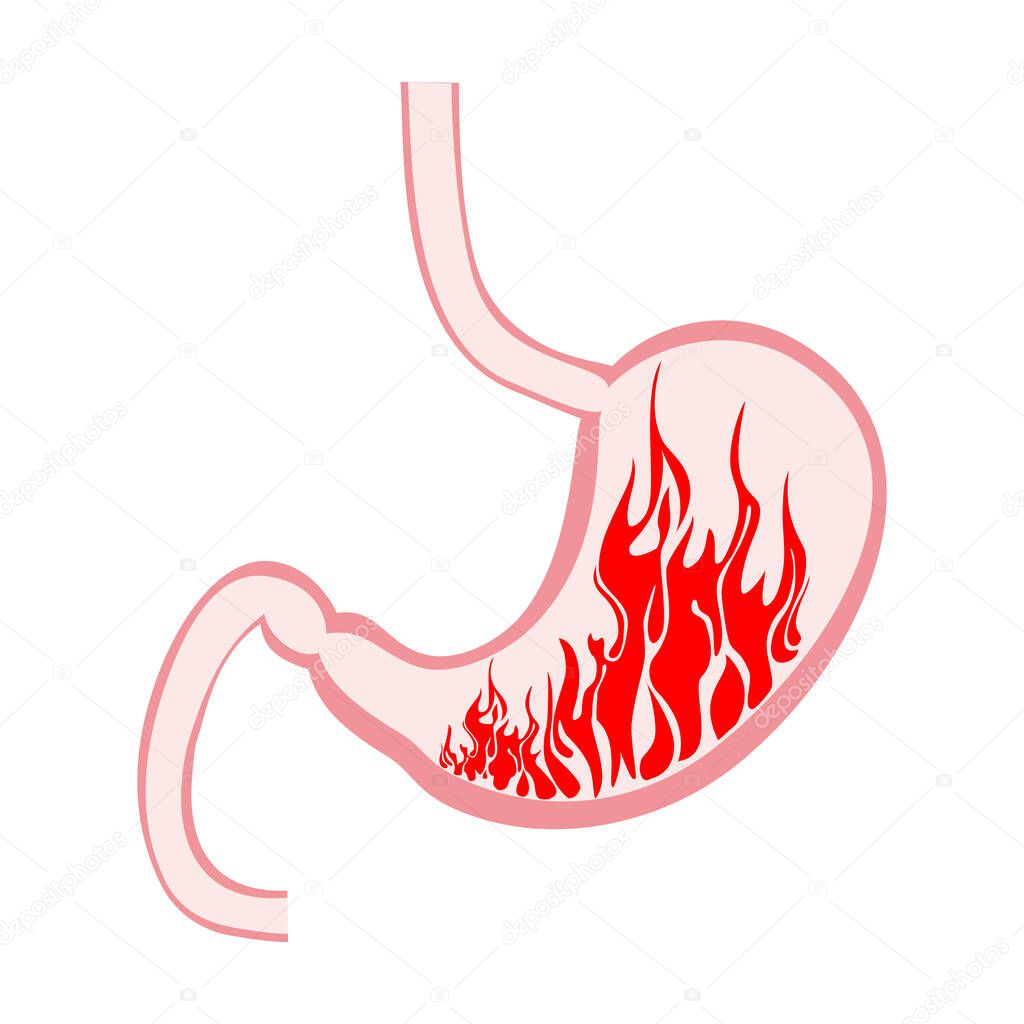 Stomach fire. Excessive acidity, indigestion, stomach disease, gastric ulcer, severe abdominal pain. Sign of stomach with heartburn