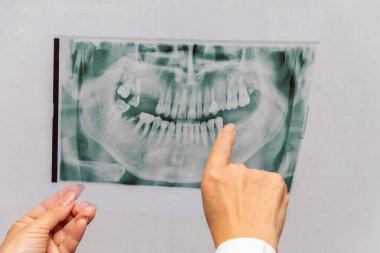 a dentist looks at an X-ray of teeth and jaw on a white background. Concept: treatment and prosthetics of the dental oral cavity.