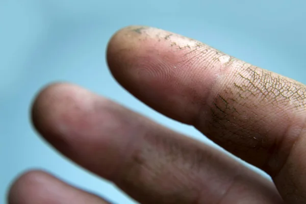 Pele rachada nos dedos, pele seca. O seu creme ajudará estas mãos. Falta de vitaminas. — Fotografia de Stock