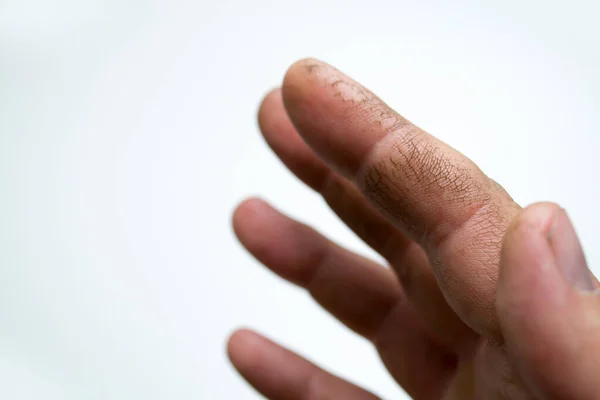 Трещины на пальцах, сухая кожа. Твой крем поможет этим рукам. Недостаток витаминов. — стоковое фото