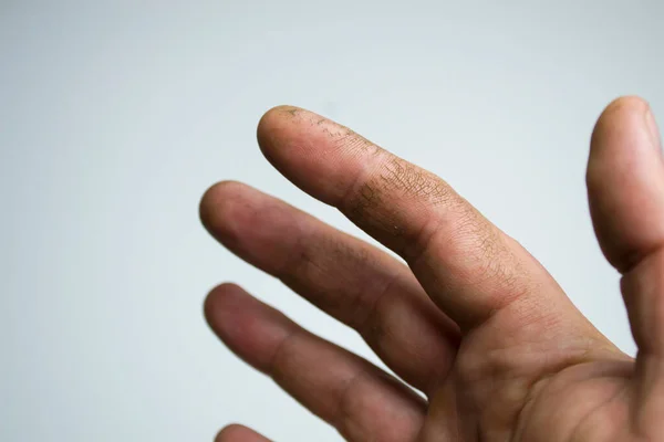 Kulit retak pada jari-jari, kulit kering. Krim Anda akan membantu tangan ini. Kurangnya vitamin.. — Stok Foto
