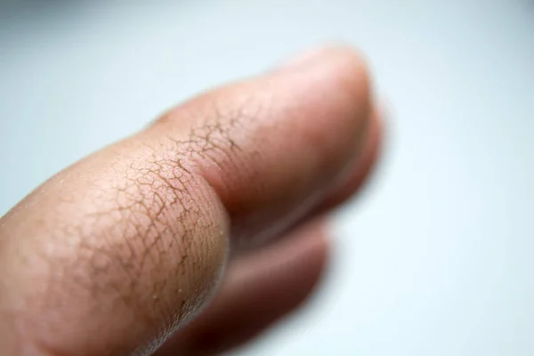 Pele rachada nos dedos, pele seca. O seu creme ajudará estas mãos. Falta de vitaminas. — Fotografia de Stock