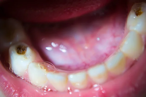 Детские зубы, стоматологическое лечение. Кариес для детей. — стоковое фото