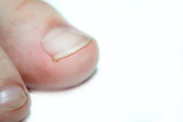 Jari-jari kaki seorang remaja dengan latar belakang putih. — Stok Foto