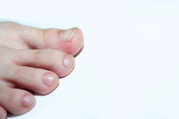 Jari-jari anak dengan latar belakang putih, artikel dan iklan tentang kesehatan kaki. — Stok Foto