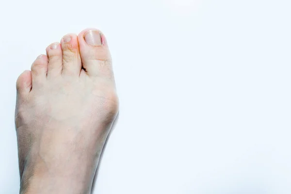Женская нога, выпирает кость больно ходить на каблуках, нога на белом фоне. — стоковое фото