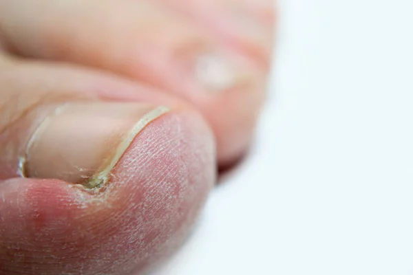 在白色的背景上剥去手指的皮，你关于足部护理的文章. — 图库照片