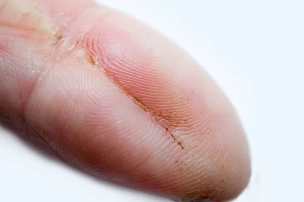 Раненый палец, залеченная рана на белом фоне. — стоковое фото